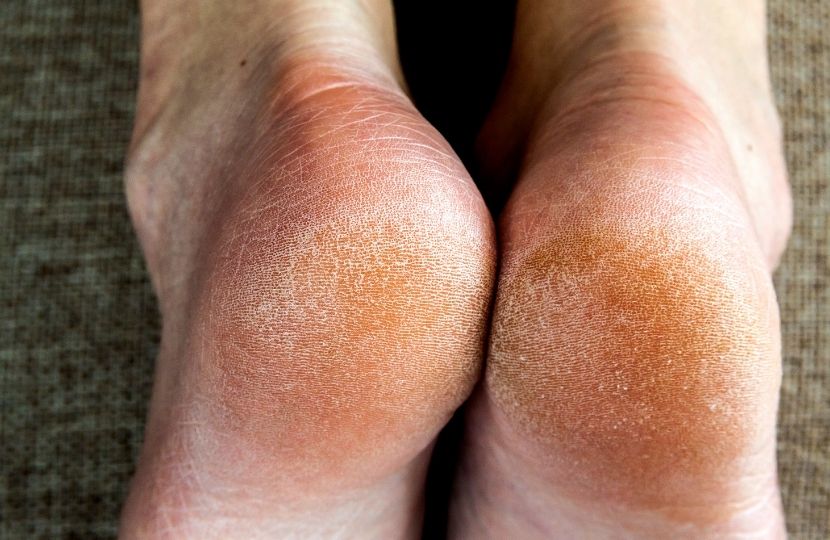 Gót chân dễ bị nứt nẻ nếu không được chăm sóc kỹ