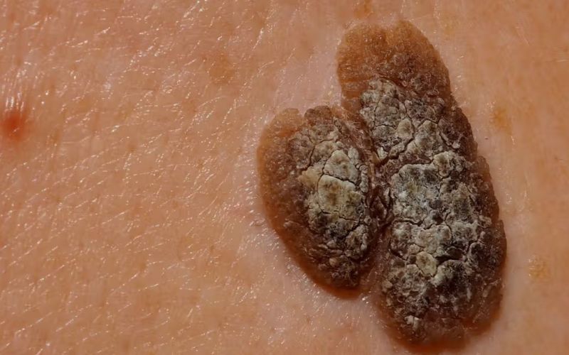 Điều trị da dầy sừng vô cùng quan trọng