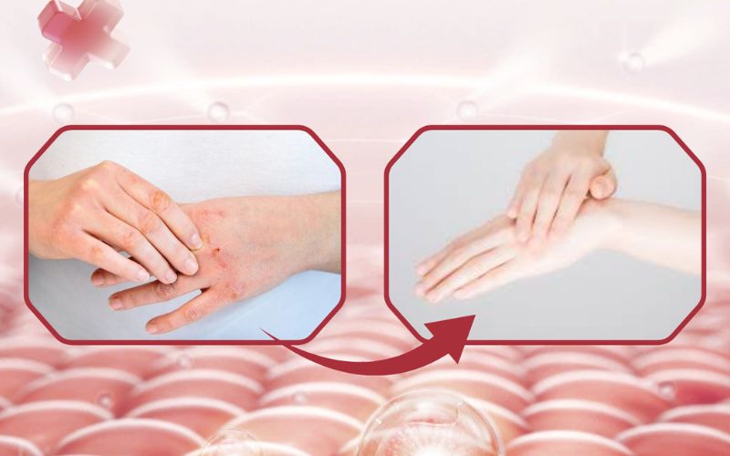 Giải pháp điều trị da dầy sừng từ Numis Med