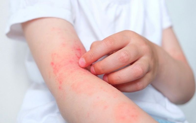 Bệnh nhân viêm da cơ địa - Đối tượng cần phục hồi hàng rào bảo vệ da