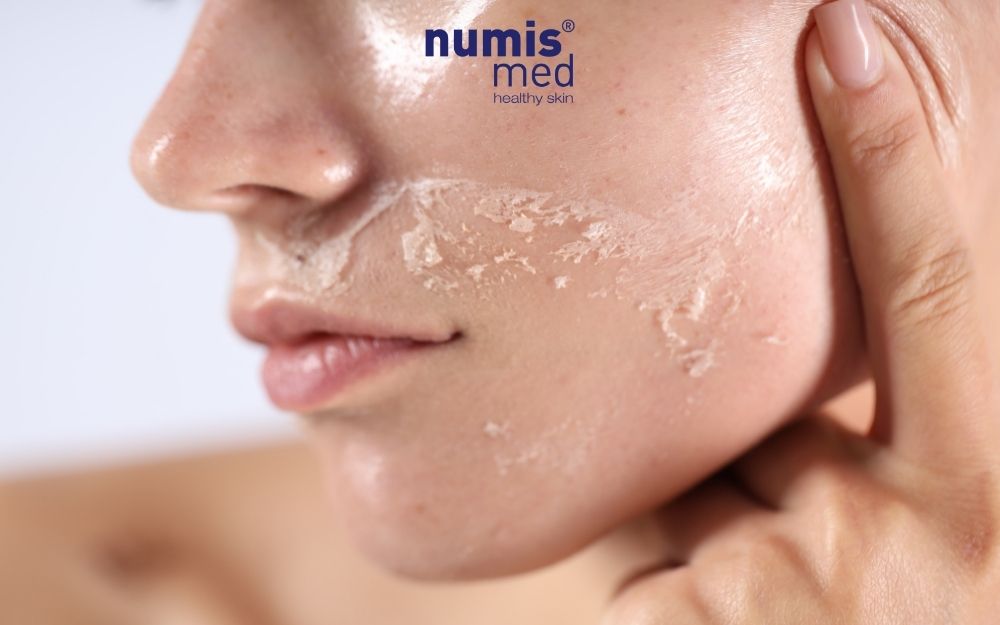 Dấu hiệu da nhạy cảm & Phân biệt kích ứng, dị ứng mỹ phẩm