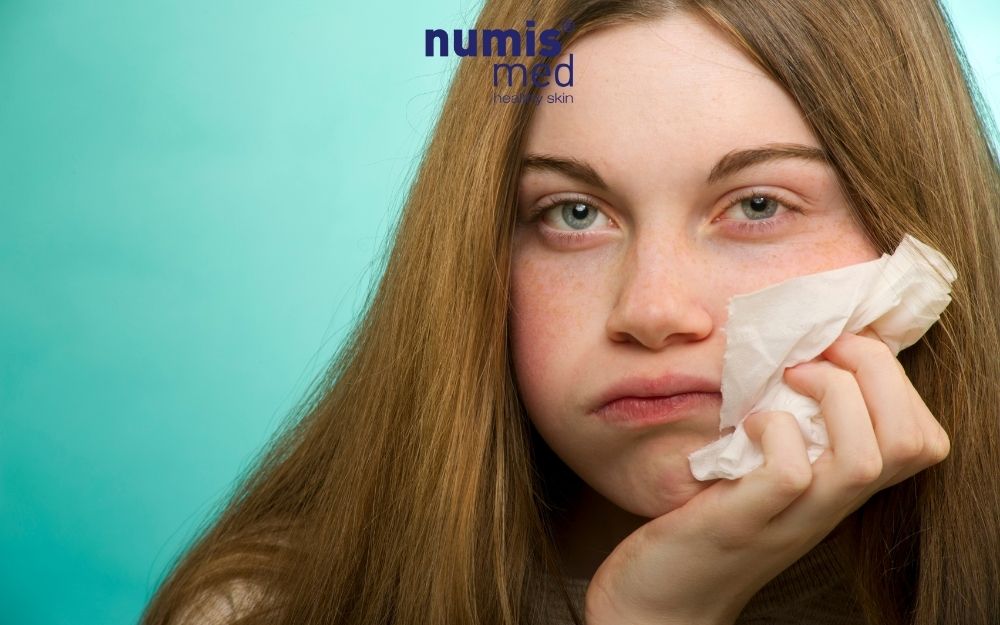 Dấu hiệu da nhạy cảm & Phân biệt kích ứng, dị ứng mỹ phẩm