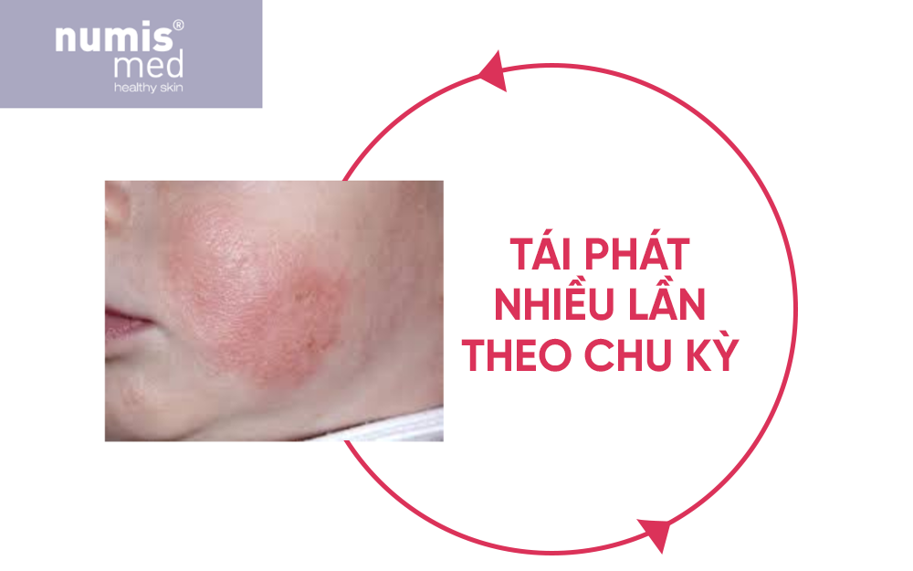 7-dau-hieu-nhan-biet-som-viem-da-co-dia-o-tre-nho