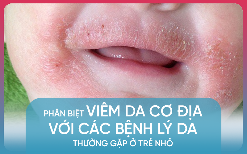 Phân biệt viêm da cơ địa với các bệnh da thường gặp ở trẻ 